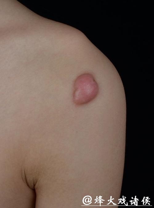 有没有人这个位置长瘢痕疙瘩? 有没有人这个位置长瘢痕疙瘩?