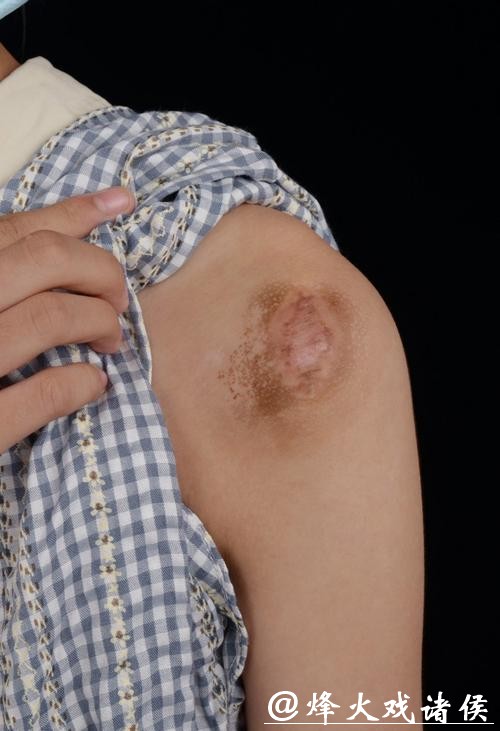 有没有人这个位置长瘢痕疙瘩? 有没有人这个位置长瘢痕疙瘩?