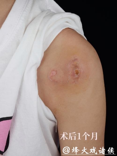 有没有人这个位置长瘢痕疙瘩? 有没有人这个位置长瘢痕疙瘩?